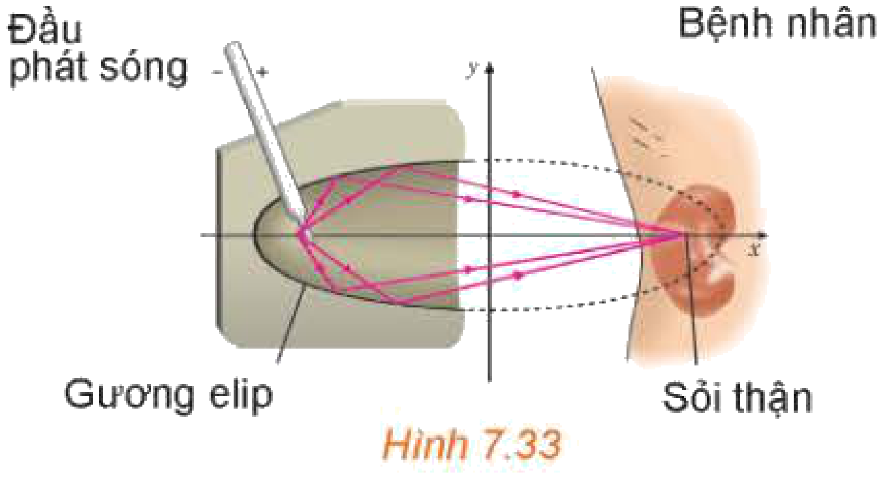 Hình 7.33: Máy tán sỏi thận